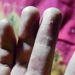 হাত-পায়ের চামড়া কেন ওঠে