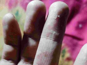 হাত-পায়ের চামড়া কেন ওঠে